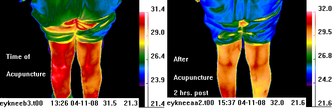 infrared image before &
                                after acupuncture