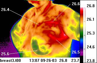 breast view with temperature values