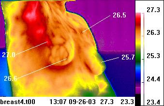 Axillary region of breast thermogram