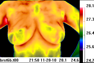 breast thermal image