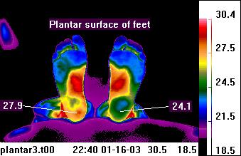 Teletherm
                            infrared image of plantar feet