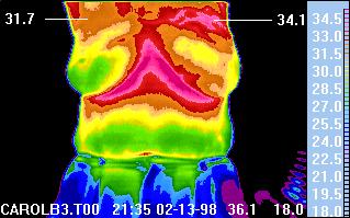 Quantitative thermographic signs nipplear heat: encircled areas show